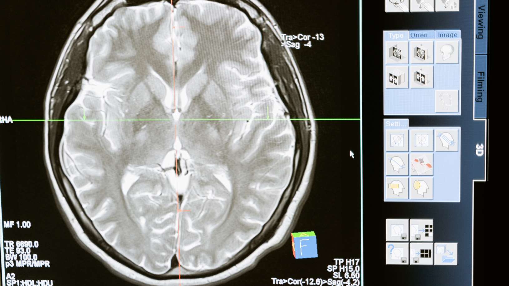 Neurodegenerative diseases